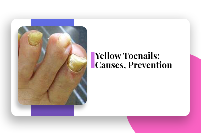 yellow toe nails